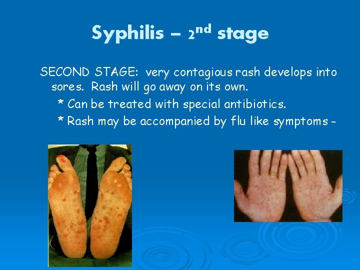 Syphilis – 2 nd stage SECOND STAGE: very contagious rash develops into sores. Rash