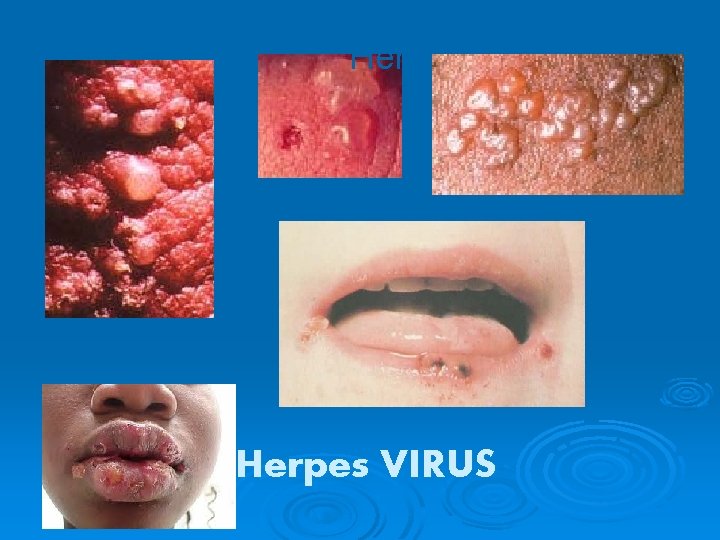 Herpes VIRUS 