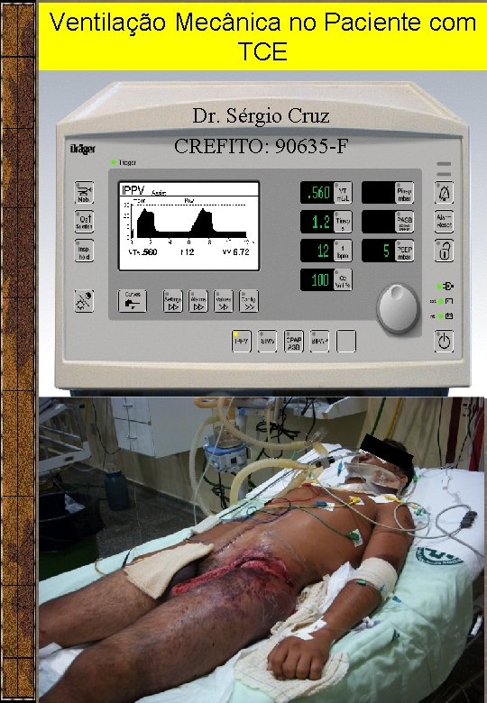 Ventilação Mecânica no Paciente com TCE Dr. Sérgio Cruz CREFITO: 90635 -F 1 Ventilação Mecânica no Paciente com TCE Dr. Sérgio Cruz CREFITO: 90635 -F 1