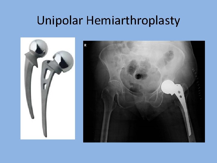 Unipolar Hemiarthroplasty 