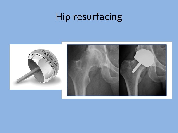 Hip resurfacing 