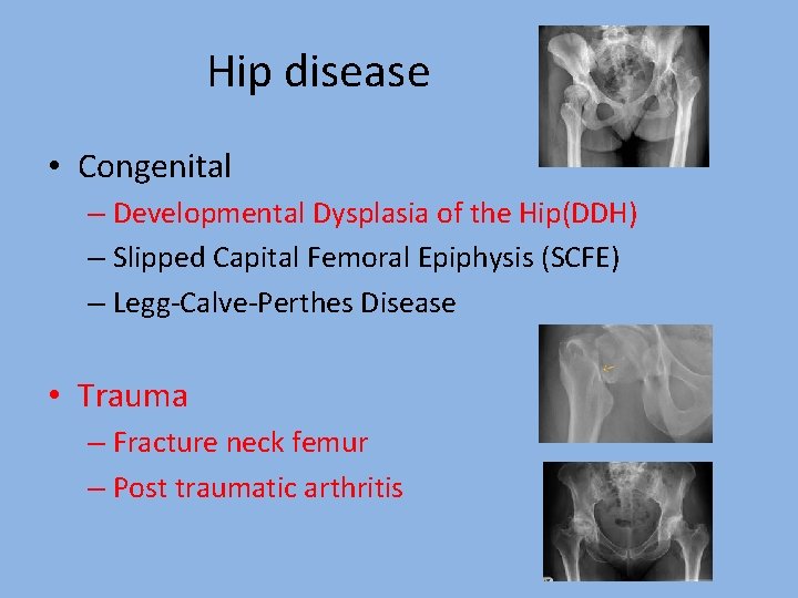 Hip disease • Congenital – Developmental Dysplasia of the Hip(DDH) – Slipped Capital Femoral