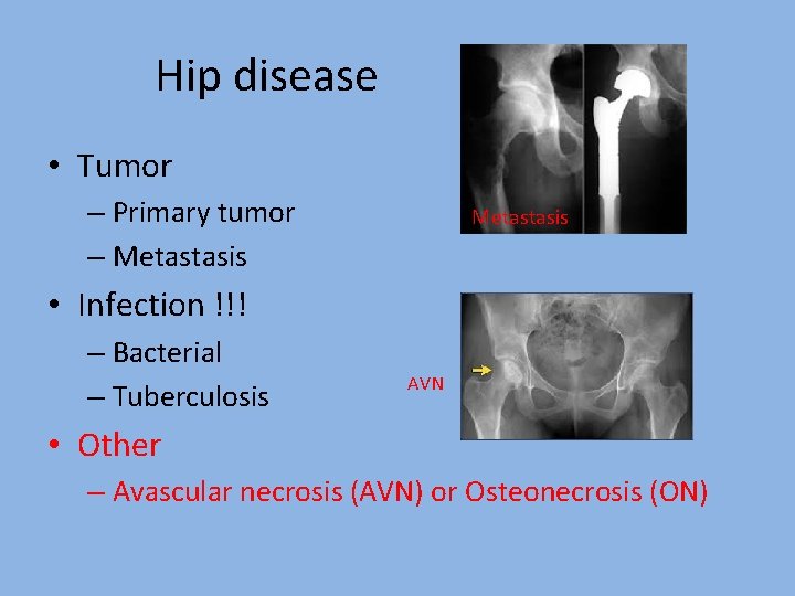 Hip disease • Tumor – Primary tumor – Metastasis • Infection !!! – Bacterial