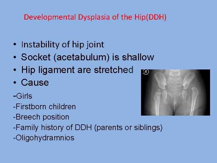 Developmental Dysplasia of the Hip(DDH) • Instability of hip joint • Socket (acetabulum) is