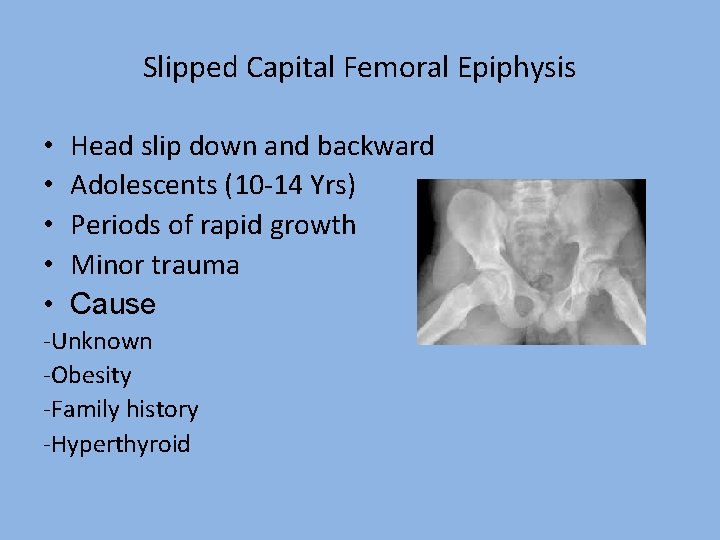 Slipped Capital Femoral Epiphysis • • • Head slip down and backward Adolescents (10