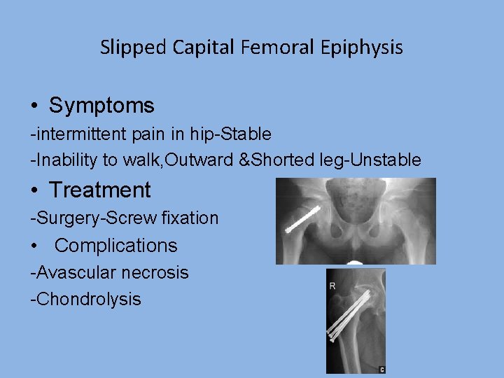 Slipped Capital Femoral Epiphysis • Symptoms -intermittent pain in hip-Stable -Inability to walk, Outward