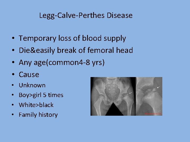Legg-Calve-Perthes Disease • • Temporary loss of blood supply Die&easily break of femoral head