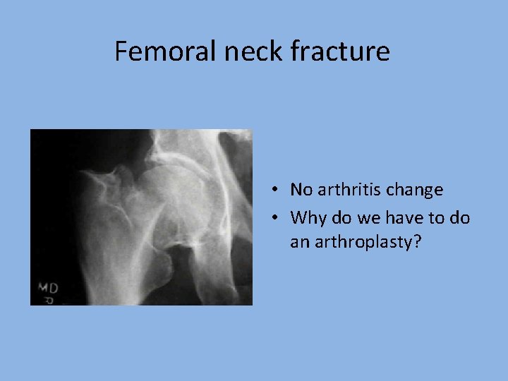 Femoral neck fracture • No arthritis change • Why do we have to do