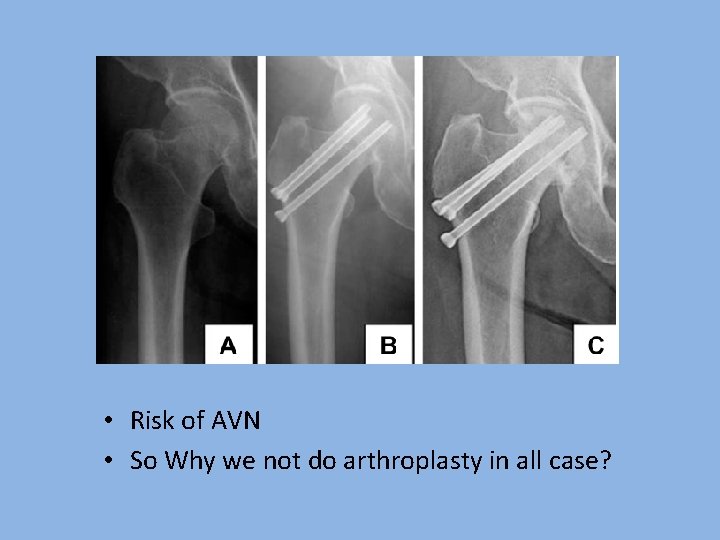  • Risk of AVN • So Why we not do arthroplasty in all