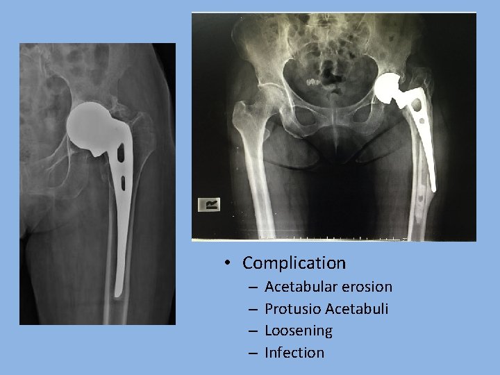  • Complication – – Acetabular erosion Protusio Acetabuli Loosening Infection 