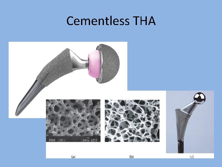 Cementless THA 