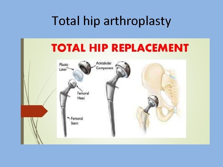 Total hip arthroplasty 