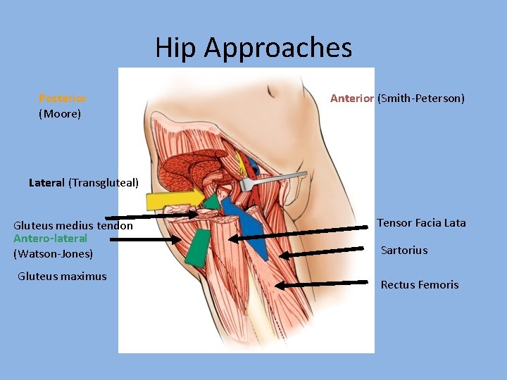 Hip Approaches Posterior (Moore) Anterior (Smith-Peterson) Lateral (Transgluteal) Gluteus medius tendon Antero-lateral (Watson-Jones) Gluteus