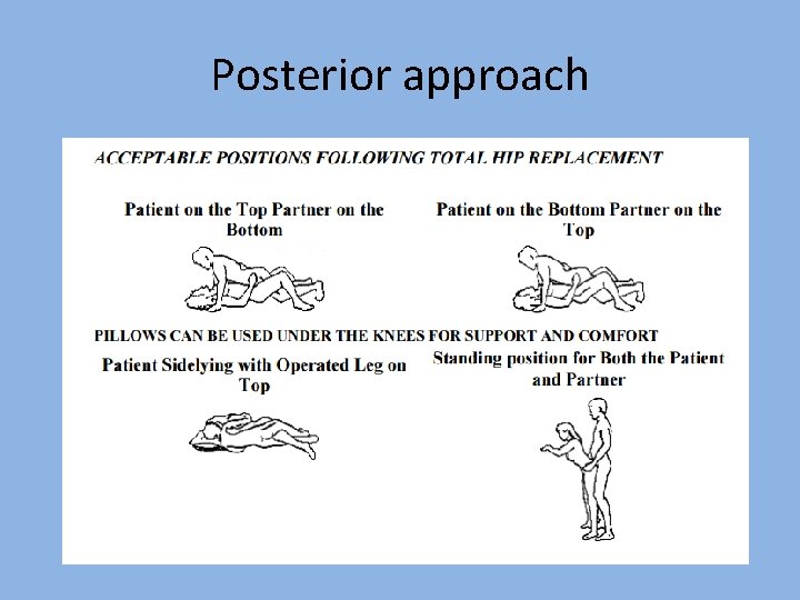 Posterior approach 