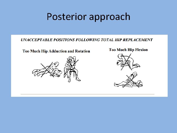 Posterior approach 