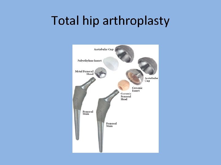 Total hip arthroplasty 