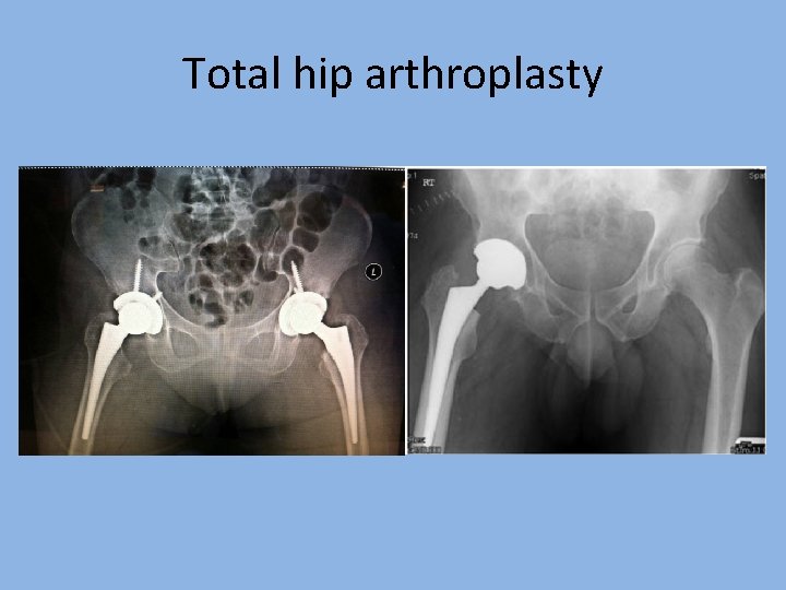 Total hip arthroplasty 
