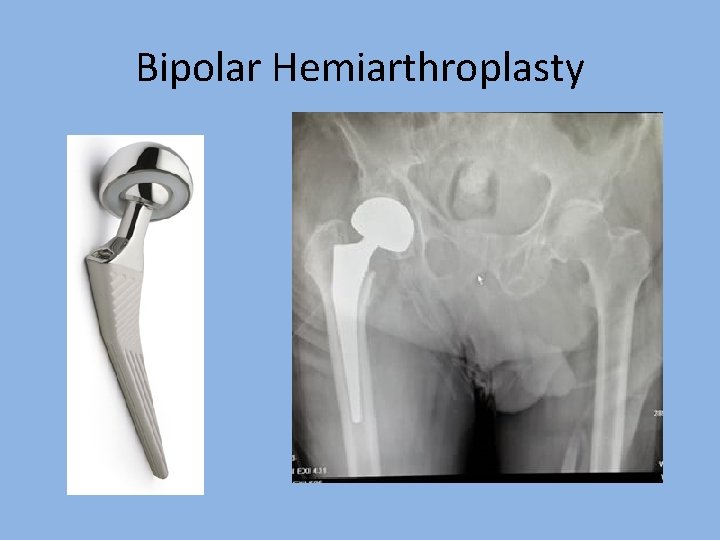 Bipolar Hemiarthroplasty 