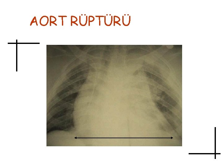 AORT RÜPTÜRÜ 