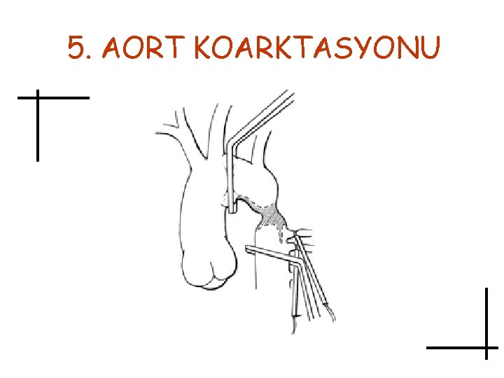 5. AORT KOARKTASYONU 