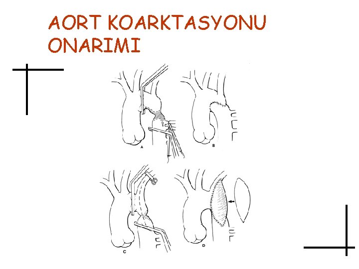 AORT KOARKTASYONU ONARIMI 