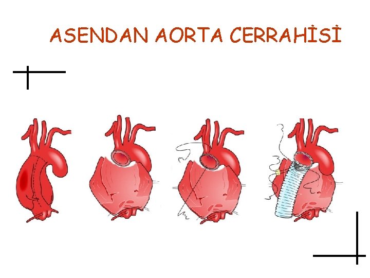 ASENDAN AORTA CERRAHİSİ 