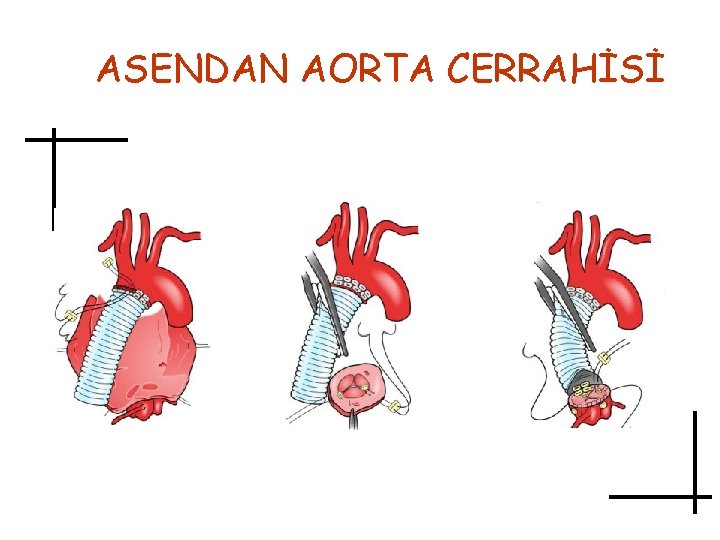 ASENDAN AORTA CERRAHİSİ 