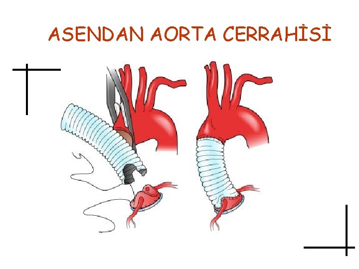 ASENDAN AORTA CERRAHİSİ 