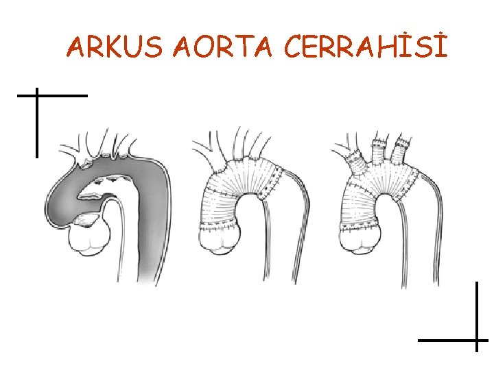 ARKUS AORTA CERRAHİSİ 
