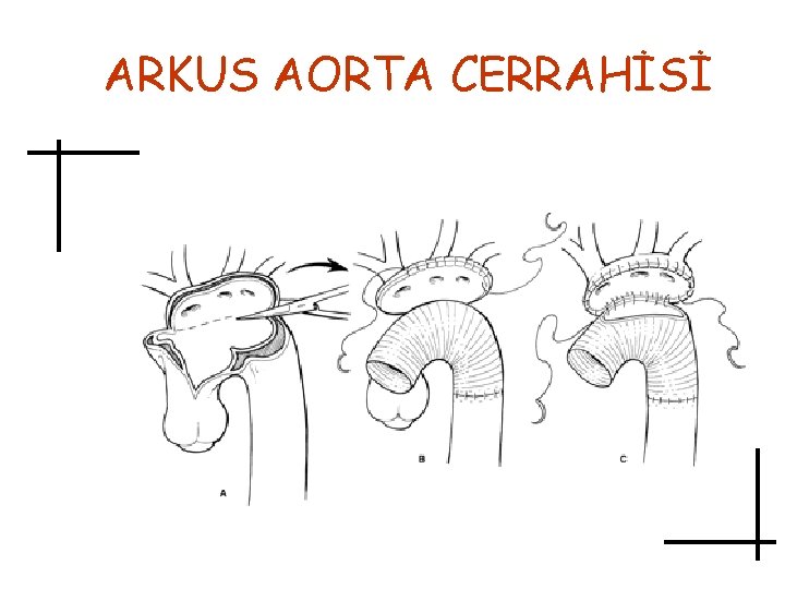 ARKUS AORTA CERRAHİSİ 