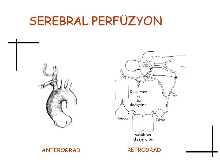 SEREBRAL PERFÜZYON Rezervuar ve Isı değiştirici Pompa Filtre Membran oksijenatör ANTEROGRAD RETROGRAD 