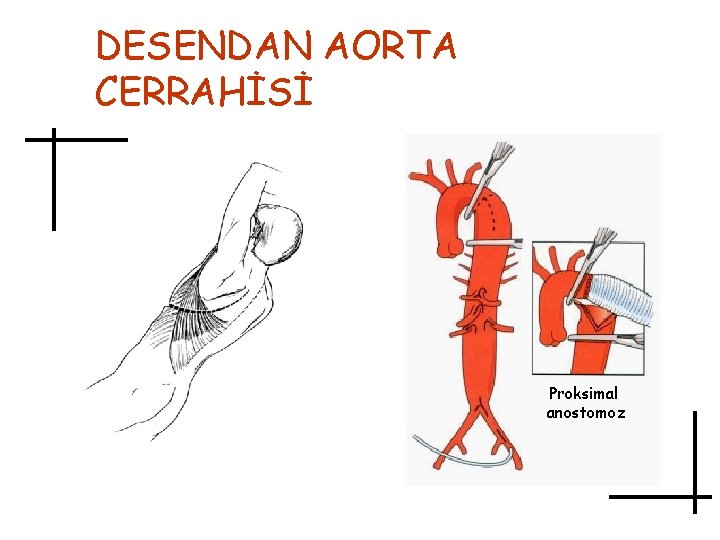 DESENDAN AORTA CERRAHİSİ Proksimal anostomoz 