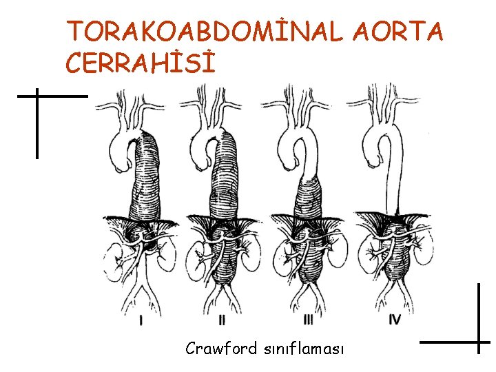 TORAKOABDOMİNAL AORTA CERRAHİSİ Crawford sınıflaması 