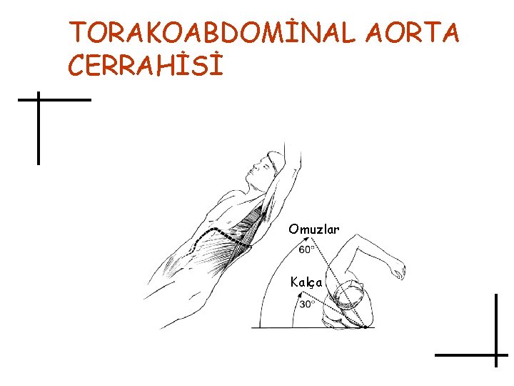 TORAKOABDOMİNAL AORTA CERRAHİSİ Omuzlar Kalça 