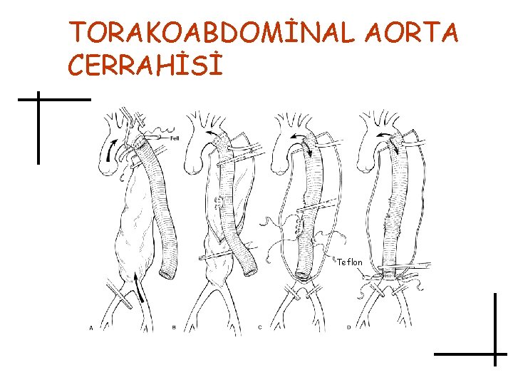 TORAKOABDOMİNAL AORTA CERRAHİSİ Teflon 