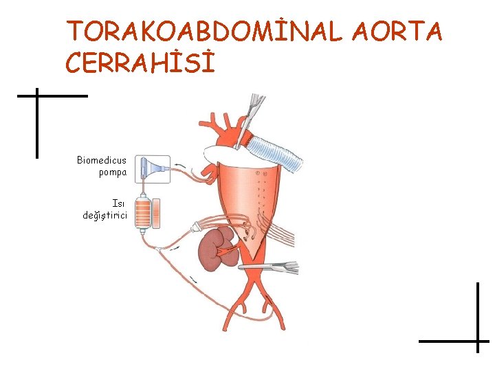 TORAKOABDOMİNAL AORTA CERRAHİSİ Biomedicus pompa Isı değiştirici 