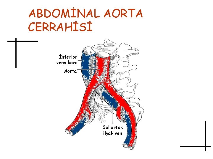 ABDOMİNAL AORTA CERRAHİSİ İnferior vena kava Aorta Sol ortak ilyak ven 