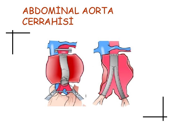 ABDOMİNAL AORTA CERRAHİSİ 