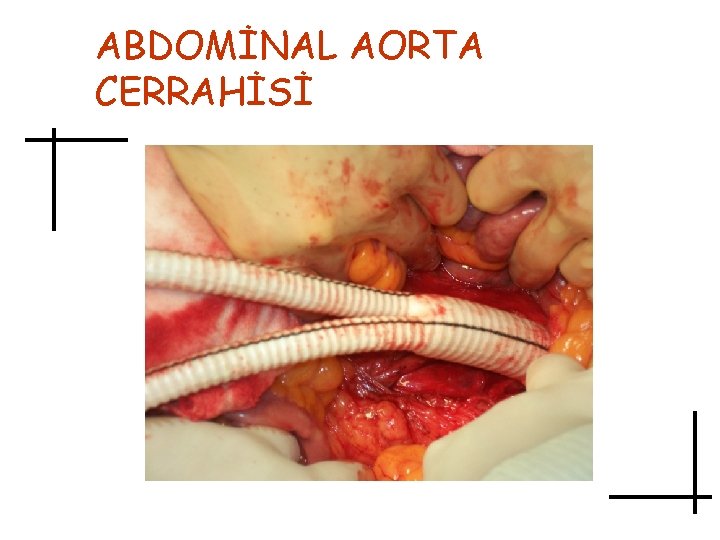 ABDOMİNAL AORTA CERRAHİSİ 