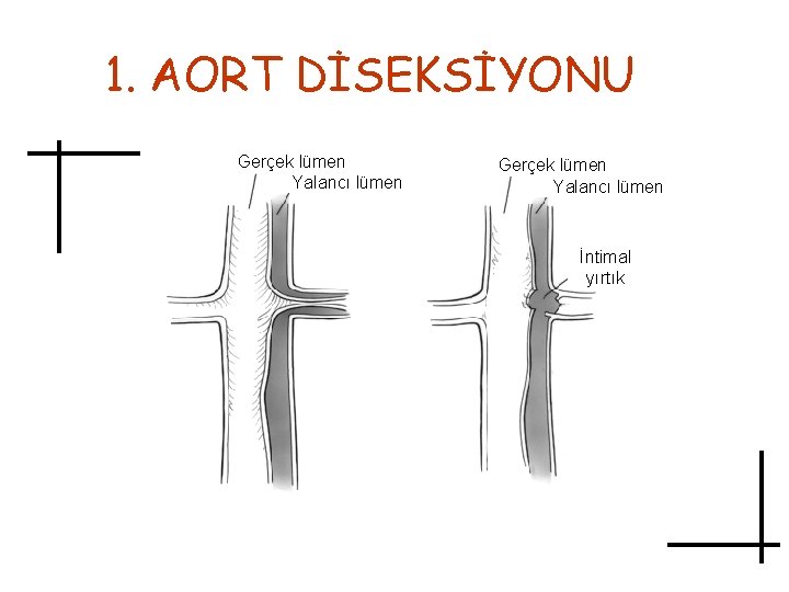 1. AORT DİSEKSİYONU Gerçek lümen Yalancı lümen İntimal yırtık 
