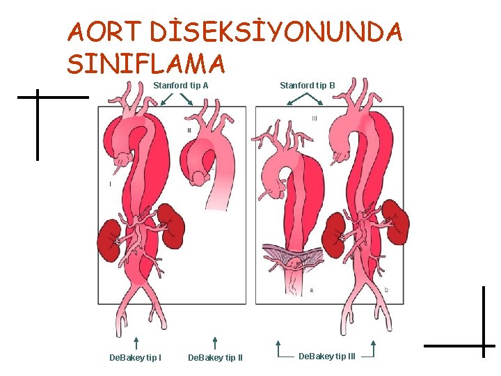 AORT DİSEKSİYONUNDA SINIFLAMA Stanford tip A De. Bakey tip II Stanford tip B De.