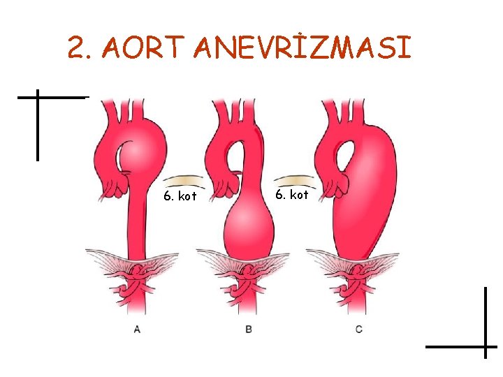 2. AORT ANEVRİZMASI 6. kot 