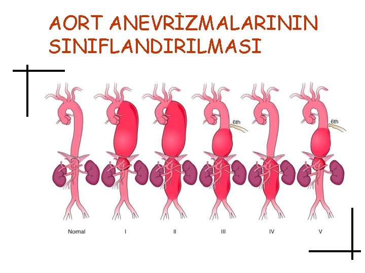 AORT ANEVRİZMALARININ SINIFLANDIRILMASI 