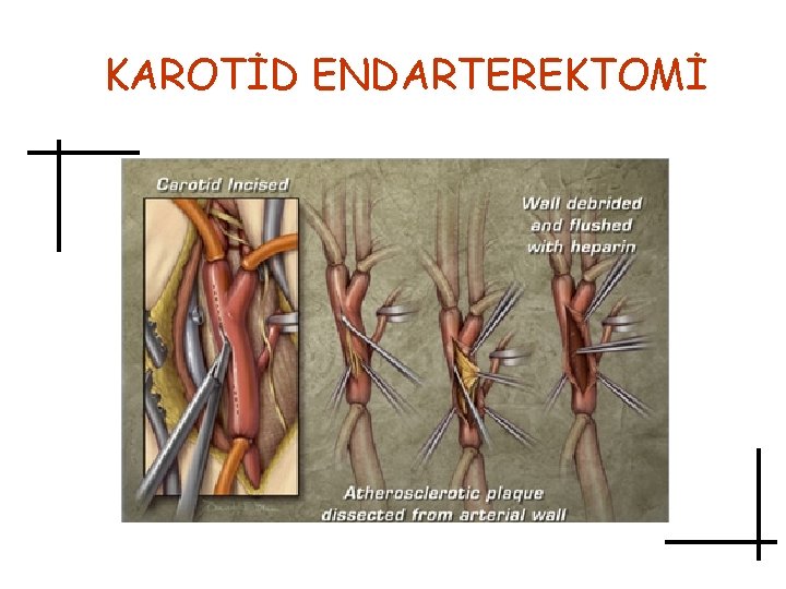 KAROTİD ENDARTEREKTOMİ 