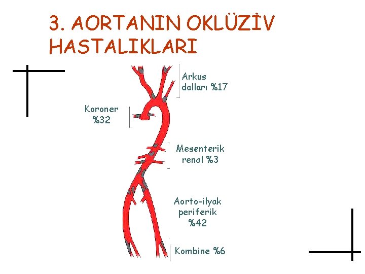 3. AORTANIN OKLÜZİV HASTALIKLARI Arkus dalları %17 Koroner %32 Mesenterik renal %3 Aorto-ilyak periferik