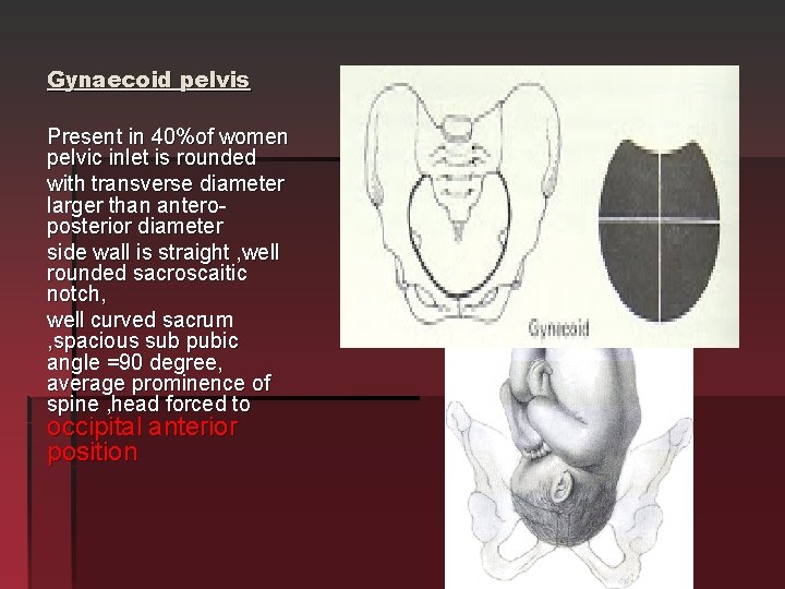 Gynaecoid pelvis Present in 40%of women pelvic inlet is rounded with transverse diameter larger