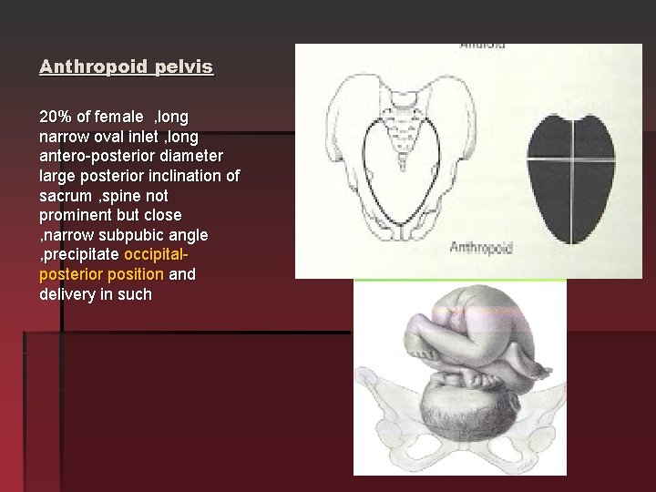 Anthropoid pelvis 20% of female , long narrow oval inlet , long antero-posterior diameter