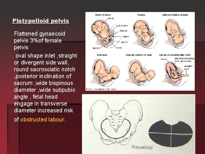 Platypelloid pelvis Flattened gynaecoid pelvis 3%of female pelvis oval shape inlet , straight or