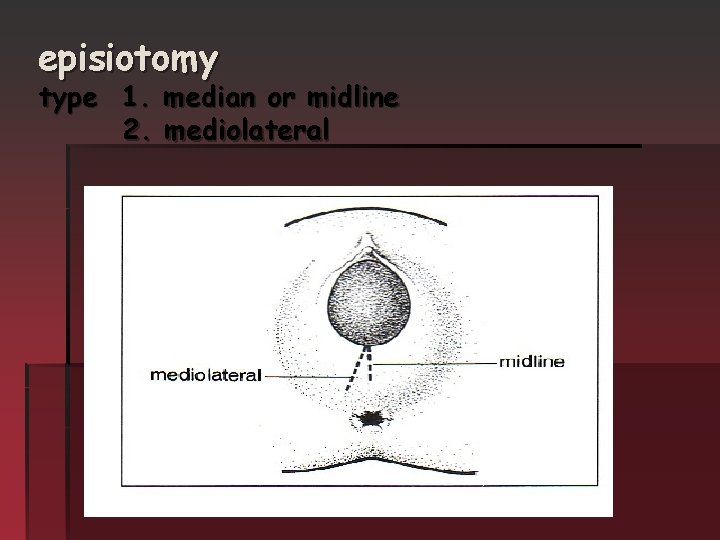 episiotomy type 1. median or midline 2. mediolateral 17 