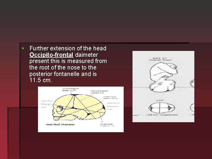 § Further extension of the head Occipito-frontal daimeter present this is measured from the